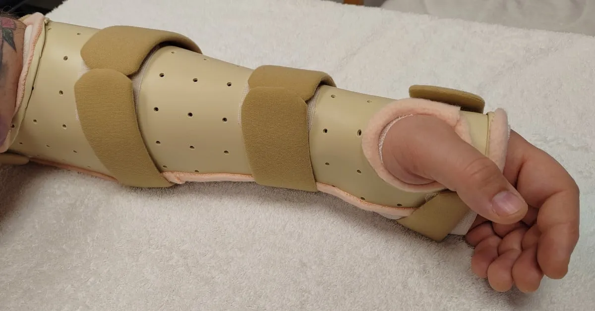 Custom Munster splint made by Ms Michelle Razo, Consultant Hand Therapist Belfast